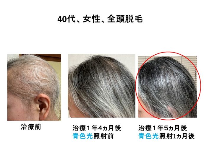 円形脱毛症　病院